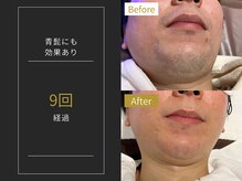 ステイゴールド 新百合ヶ丘(STAY GOLD)/おヒゲ脱毛の経過☆