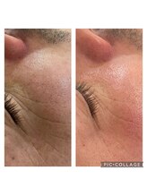 ヨロ 梅郷店(YOLO)/光フェイシャル