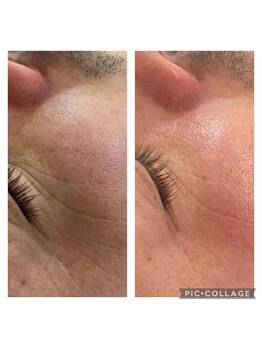 ヨロ 梅郷店(YOLO)/光フェイシャル