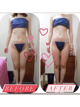 エストビューティー 心斎橋店/新鋭機械で施術（太もも）