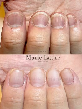 マリーロール 淀屋橋本店(Marie Laure)/深爪矯正/自爪風/自爪育成