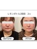 【二重あご・フェイスライン♪】韓国美容/お顔レモンボトル導入2cc（６０分）