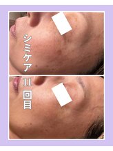 ムーンアンドアース(moon&earth)/フォト＆シミケア