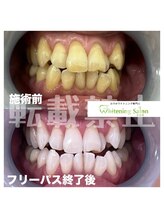 ホワイトニングサロン 札幌店&nbsp;通い放題 