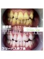 ホワイトニングサロン 札幌店 通い放題