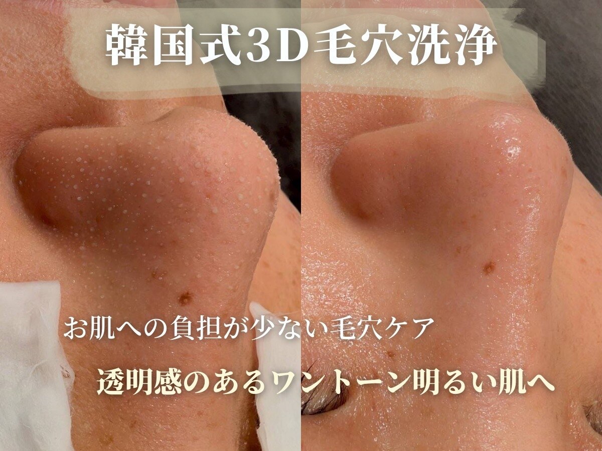 【メンバー様】韓国式3D毛穴洗浄15,400円→14,300円