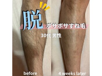 サロン(SALON)/メンズ脱毛：脚