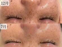 サロンドエテ(salon de ete)/シミケア