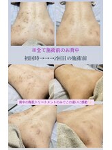 クレヴィー(Creviy)/背中ハーブピーリング