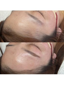 ラティーク 諫早西口店/マリムーブフェイシャルWAX