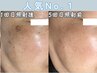 No.1【濃いシミを早く綺麗にしたい方はこちら】シミ集中ケア付光フォト