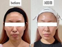 マカオン(machaon)/【小顔リフト】小顔マッサージ