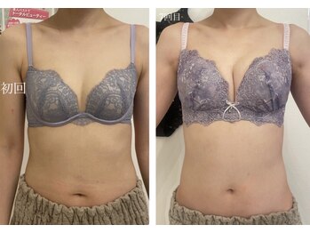 美人バスト 南森町店/バストアップ◇症例◇