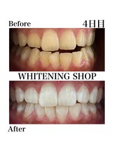 ホワイトニングショップ 豊橋店(WHITENING SHOP)/Before&After　4日目のお客様