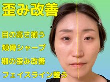 ナチュラルパーフェクトフェイス 新宿/頬骨の悩み/新宿駅小顔矯正