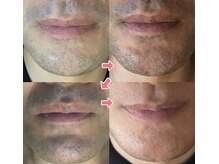 ニコル 高千穂通店(NICOLE)/men'sヒゲ脱毛