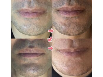 ニコル 高千穂通店(NICOLE)/men'sヒゲ脱毛