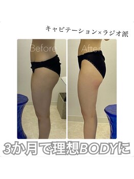 キレピア 熊本インター店(kirepia)/キャビテーション3ヶ月目♪