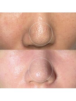 ソワ 吉塚店(soi)/毛穴の汚れがすっきり♪