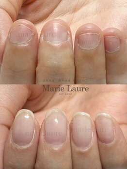 マリーロール 梅田店(Marie Laure)/自爪育成/深爪矯正/ネイルケア