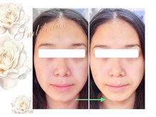 スマイルデイズ(Smiledays)/施術結果　30代前半