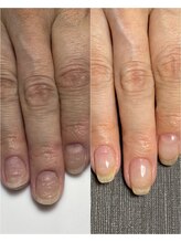 サンマルイチ(301)/自爪育成／クリア／トラブル爪