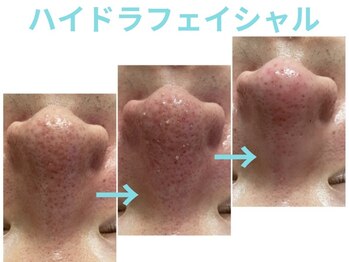 ライズ 岩見沢店(RISE)/【ハイドラ】ビフォーアフター