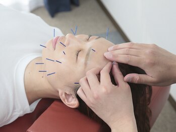 ハレルヤ鍼灸治療院/美容鍼