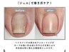 【モニター募集】巻爪改善ジェル2本【通常7,500円→期間限定4,499円！！】
