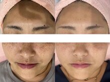 サクラ 伊勢原店(SAKURA)/王道シミケアフェイシャルエステ