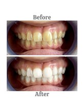 エクシアホワイトニング 相模大野店/ビフォーアフター