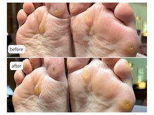 カシェット(Cachette)/40代女性◎足裏角質ケア90分