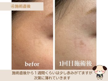 ソワン/フェイシャル/毛穴/小顔/シミ