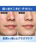 【繰り返すニキビ、なかなか引かないニキビでお悩みの方】プラズマニキビケア
