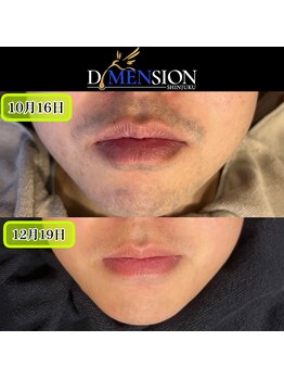 ディメンション 新宿(DiMENSION)/脱毛して2ヶ月目