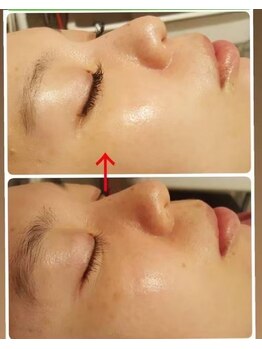 ミュー パピヤン(mue papillant)/ビフォーアフター【美白】