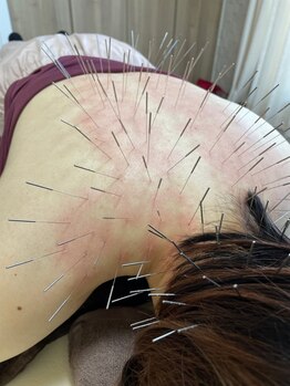 葵の葉鍼灸院の写真/お悩みの原因を徹底追及し、高い技術を提供！お客様のお体の状態に合わせた施術でお悩みを改善します。