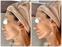 ルー ハナレ 神戸岡本 摂津本山店(Luu HANARE)/リフトアップ　しわ改善　艶肌