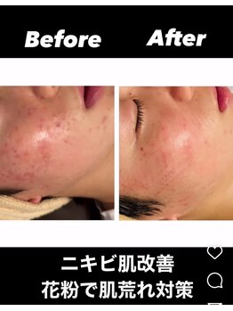 フーレスト アンド フリーリー(Fullest&Freely)/ハーブピーリング