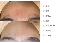 ピュアノア 垂水店/ 産毛脱毛 顔脱毛  神戸垂水明石