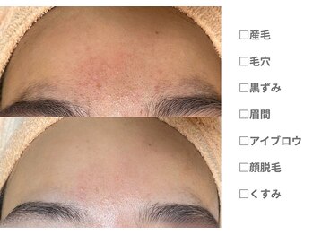 ピュアノア 垂水店/ 産毛脱毛 顔脱毛  神戸垂水明石