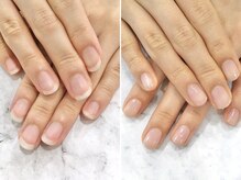 リファーレ(RIFARE)/【深爪矯正】憧れの縦長爪に♪