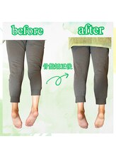 リコア(Re`core)/術後のビフォーアフター【骨盤】