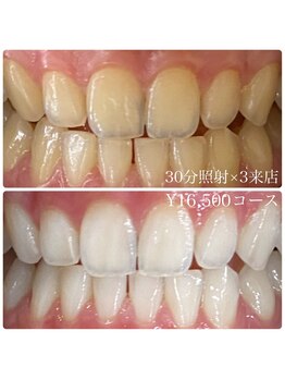 ホワイトニングルーム 川崎店(WhiteningRoom)/ホワイトニング/川崎
