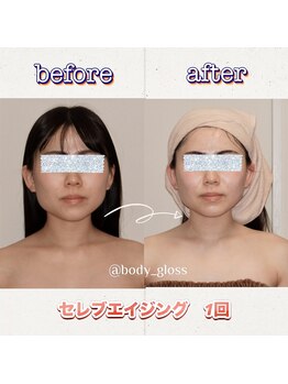 ボディグロス 梅田店(BODY GLOSS)/ブライダルフェイシャルに最適！