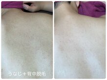 フォーチューン/うなじ＋背中脱毛♪