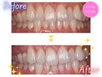 エクシアホワイトニング 前橋店/ビフォーアフター