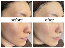 アリエス/肌質改善［ザラつき］