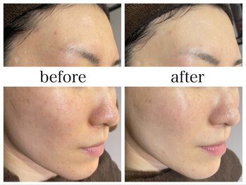 アリエス/肌質改善［ザラつき］