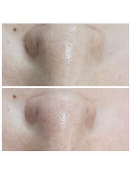 エターナル(Eternal)/小鼻のザラつき気になりますよね